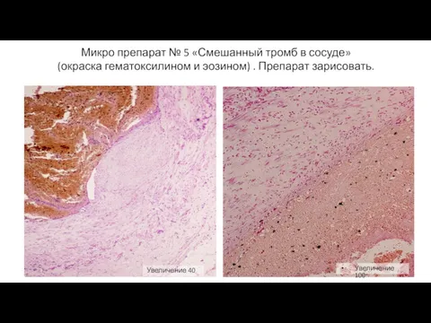 Микро препарат № 5 «Смешанный тромб в сосуде» (окраска гематоксилином