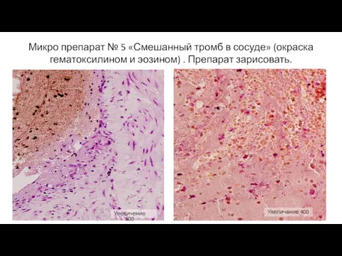 Микро препарат № 5 «Смешанный тромб в сосуде» (окраска гематоксилином
