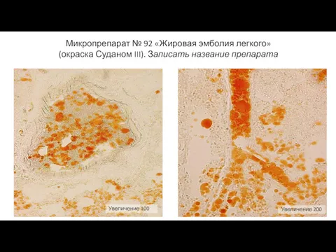 Микропрепарат № 92 «Жировая эмболия легкого» (окраска Суданом III). Записать название препарата Увеличение 100 Увеличение 200
