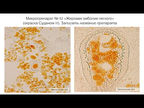 Микропрепарат № 92 «Жировая эмболия легкого» (окраска Суданом III). Записать название препарата Увеличение 200 Увеличение 400