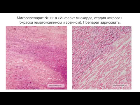 Микропрепарат № 111а «Инфаркт миокарда, стадия некроза» (окраска гематоксилином и