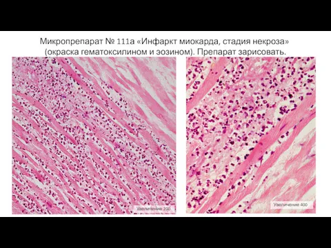 Микропрепарат № 111а «Инфаркт миокарда, стадия некроза» (окраска гематоксилином и