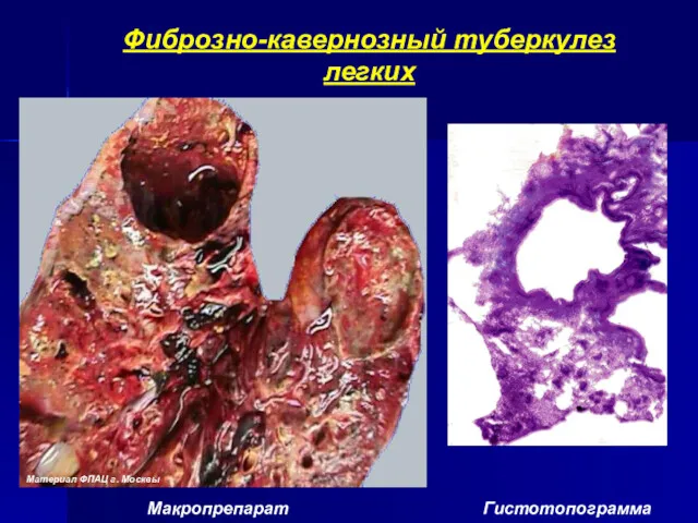 Фиброзно-кавернозный туберкулез легких Макропрепарат Гистотопограмма Материал ФПАЦ г. Москвы