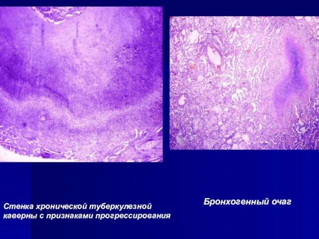 3 Стенка хронической туберкулезной каверны с признаками прогрессирования Бронхогенный очаг