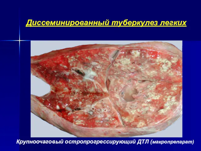 Диссеминированный туберкулез легких Крупноочаговый остропрогрессирующий ДТЛ (макропрепарат)