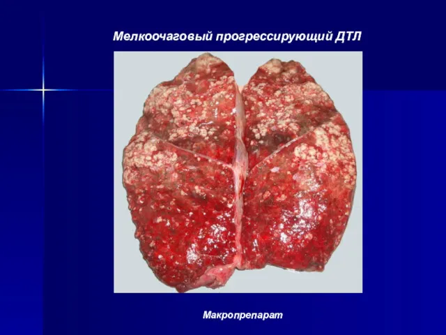 Мелкоочаговый прогрессирующий ДТЛ Макропрепарат