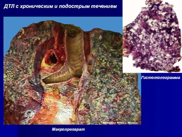 ДТЛ с хроническим и подострым течением Макропрепарат Гистотопограмма Материал ФПАЦ г. Москвы