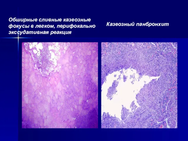 Обширные сливные казеозные фокусы в легком, перифокально экссудативная реакция Казеозный панбронхит