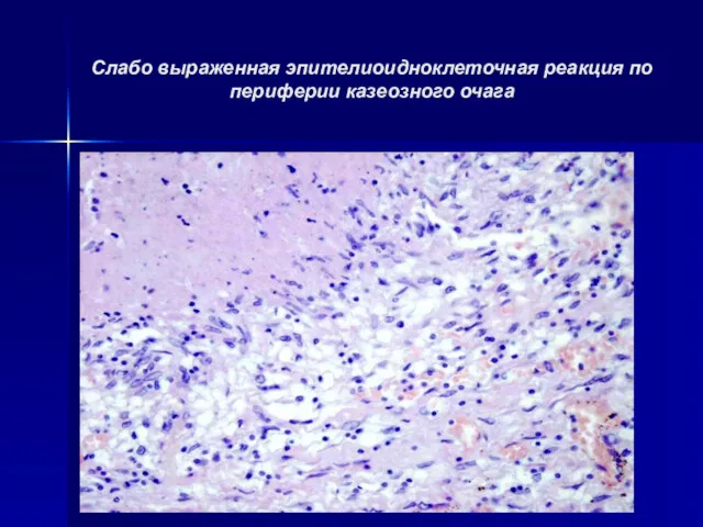 Слабо выраженная эпителиоидноклеточная реакция по периферии казеозного очага