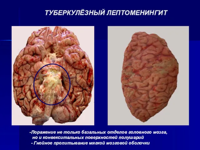 ТУБЕРКУЛЁЗНЫЙ ЛЕПТОМЕНИНГИТ Поражение не только базальных отделов головного мозга, но