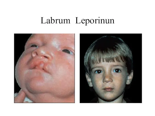 Labrum Leporinun