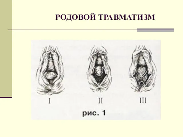 РОДОВОЙ ТРАВМАТИЗМ