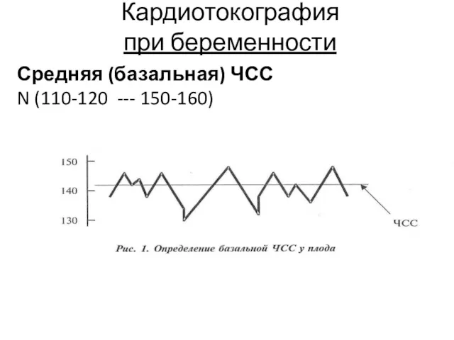 Кардиотокография при беременности Средняя (базальная) ЧСС N (110-120 --- 150-160)