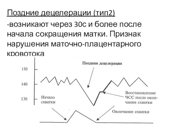 Поздние децелерации (тип2) -возникают через 30с и более после начала сокращения матки. Признак нарушения маточно-плацентарного кровотока