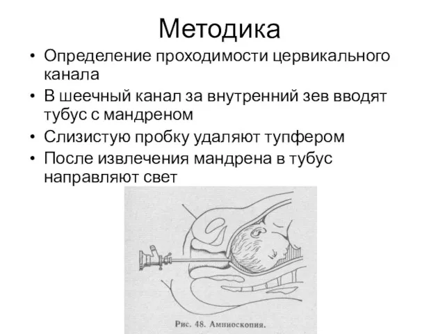 Методика Определение проходимости цервикального канала В шеечный канал за внутренний