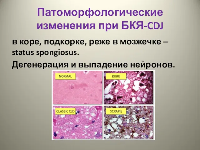 Патоморфологические изменения при БКЯ-CDJ в коре, подкорке, реже в мозжечке