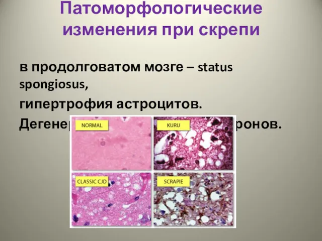 Патоморфологические изменения при скрепи в продолговатом мозге – status spongiosus, гипертрофия астроцитов. Дегенерация и выпадение нейронов.