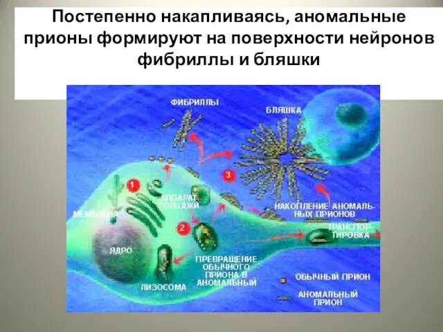 Постепенно накапливаясь, аномальные прионы формируют на поверхности нейронов фибриллы и бляшки