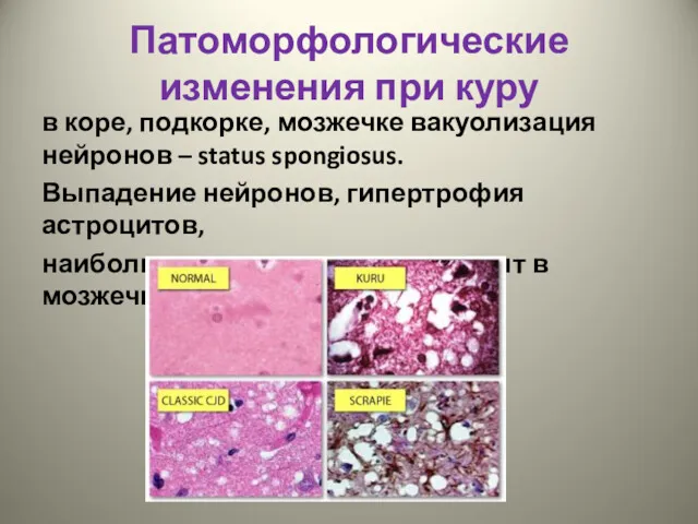 Патоморфологические изменения при куру в коре, подкорке, мозжечке вакуолизация нейронов