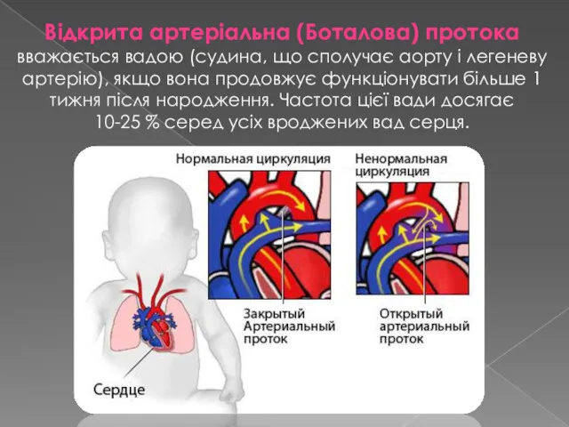 Відкрита артеріальна (Боталова) протока вважається вадою (судина, що сполучає аорту