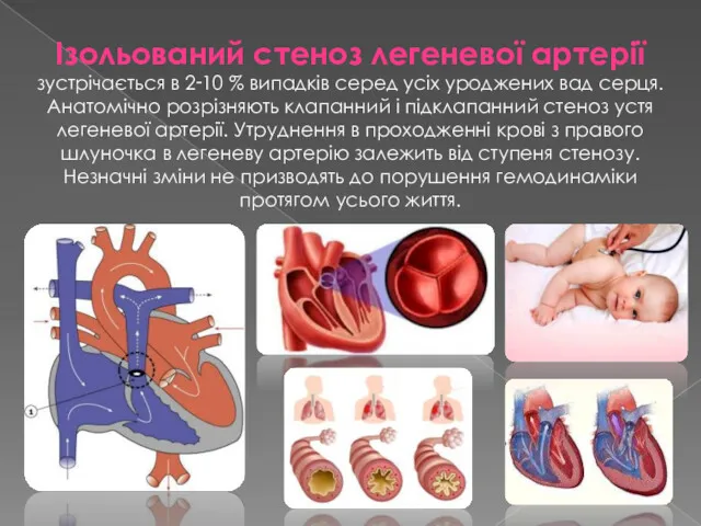 Ізольований стеноз легеневої артерії зустрічається в 2‑10 % випадків серед