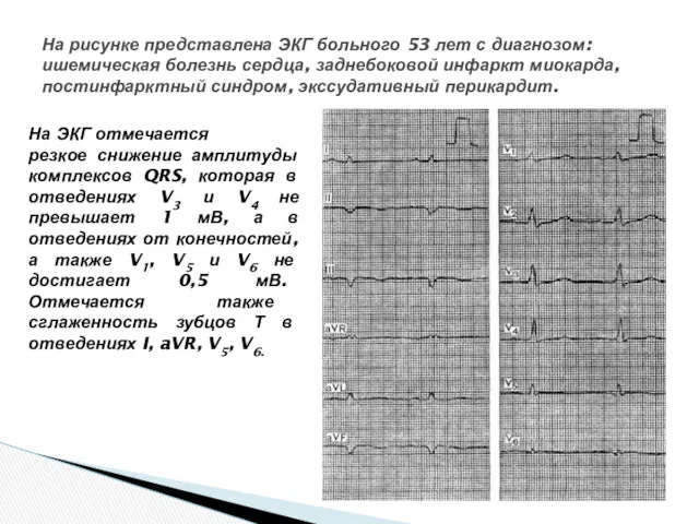 На рисунке представлена ЭКГ больного 53 лет с диагнозом: ишемическая болезнь сердца, заднебоковой