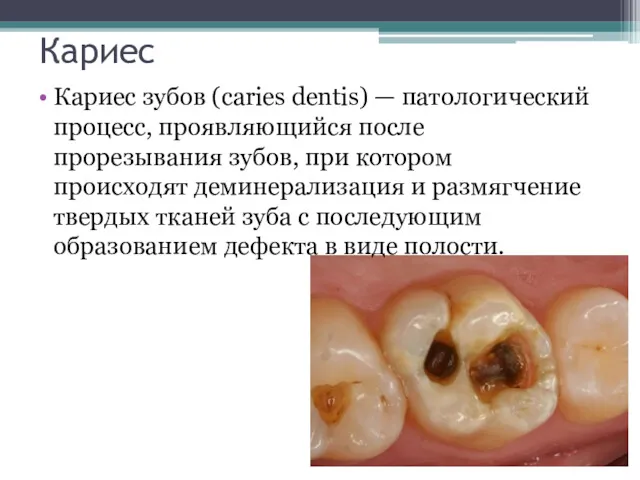 Кариес Кариес зубов (caries dentis) — патологический процесс, прояв­ляющийся после