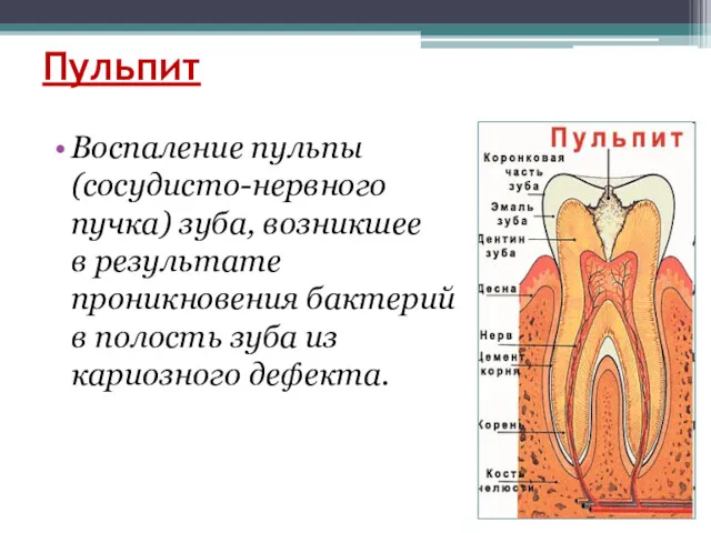 Пульпит Воспаление пульпы (сосудисто-нервного пучка) зуба, возникшее в результате проникновения