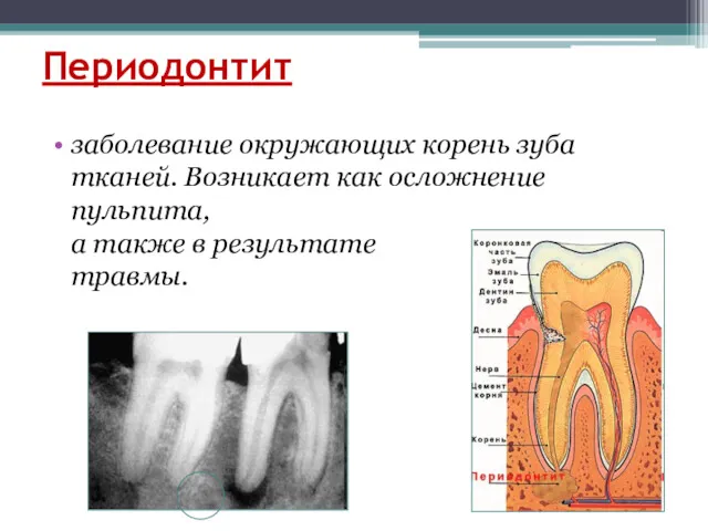 Периодонтит заболевание окружающих корень зуба тканей. Возникает как осложнение пульпита, а также в результате травмы.