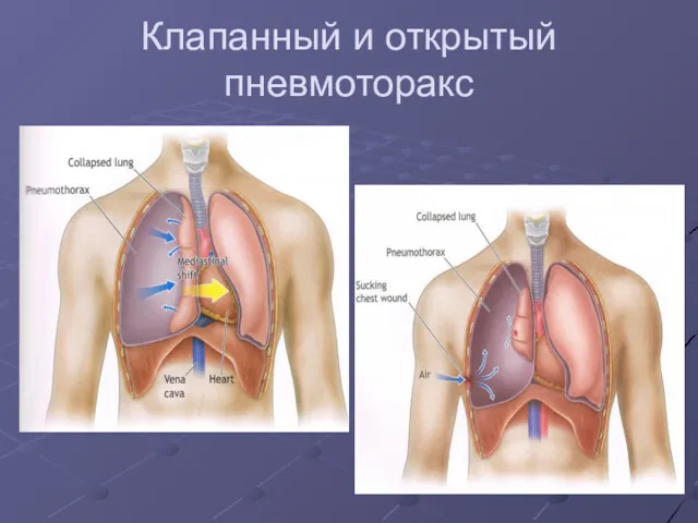 Клапанный и открытый пневмоторакс