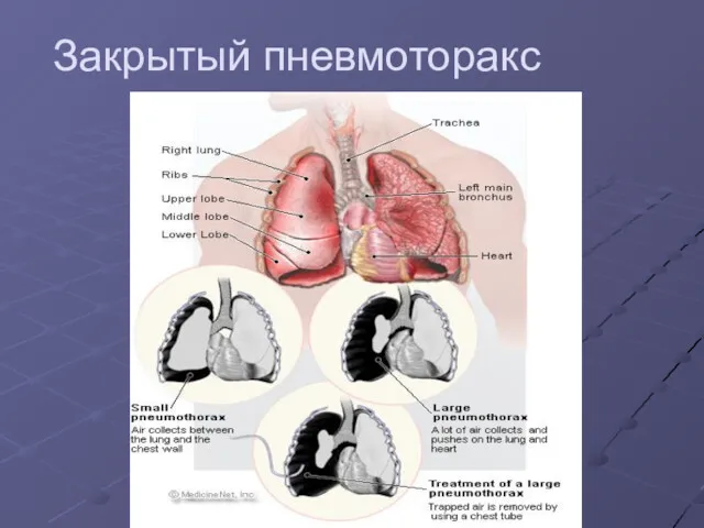 Закрытый пневмоторакс