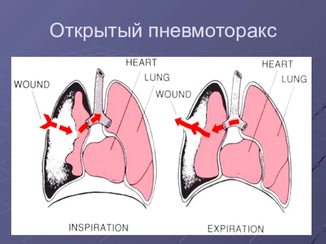 Открытый пневмоторакс