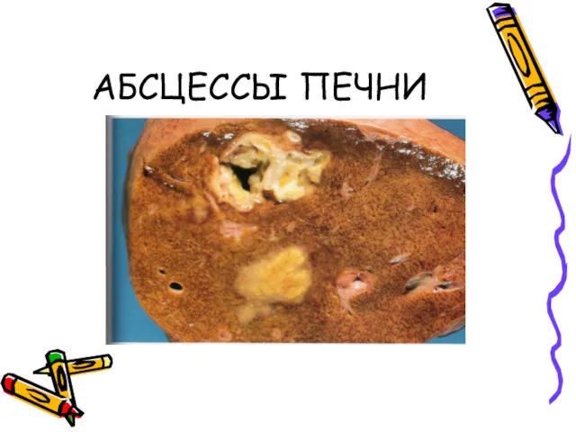 АБСЦЕССЫ ПЕЧНИ