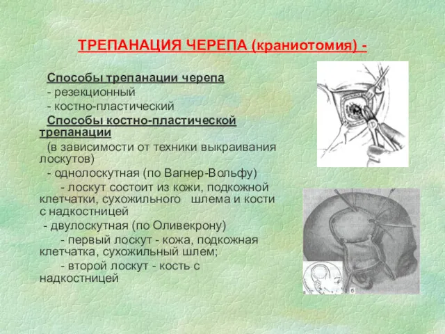 ТРЕПАНАЦИЯ ЧЕРЕПА (краниотомия) - Способы трепанации черепа - резекционный - костно-пластический Способы костно-пластической
