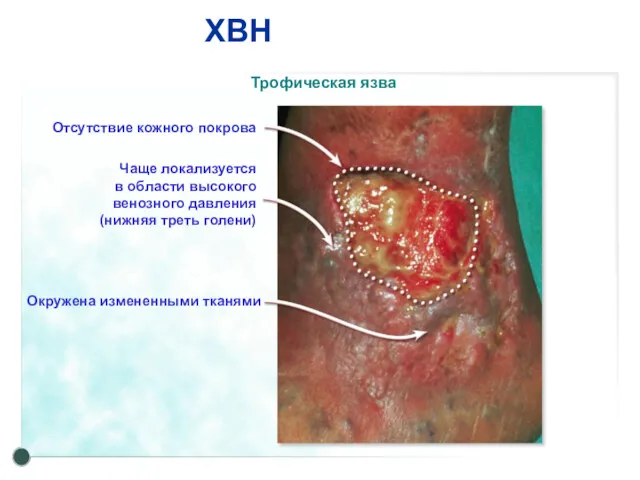Трофическая язва ХВН Отсутствие кожного покрова Чаще локализуется в области