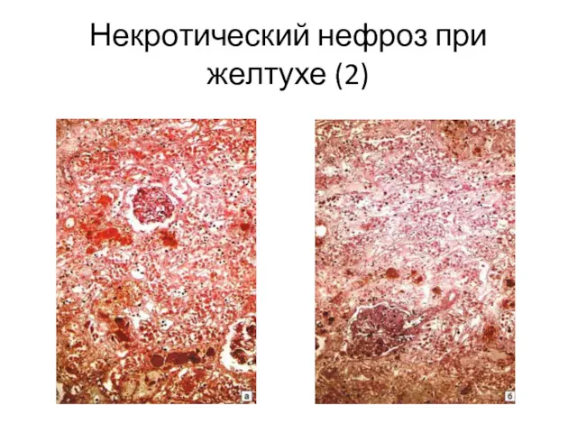 Некротический нефроз при желтухе (2)