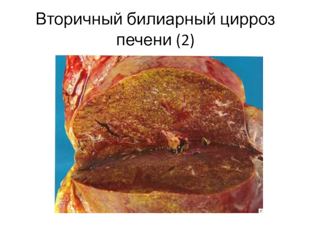 Вторичный билиарный цирроз печени (2)