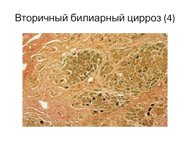 Вторичный билиарный цирроз (4)