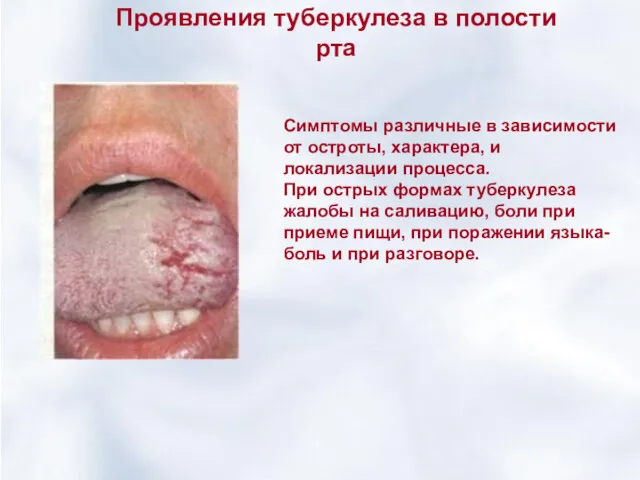 Проявления туберкулеза в полости рта Симптомы различные в зависимости от