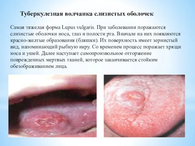 Туберкулезная волчанка слизистых оболочек Самая тяжелая форма Lupus vulgaris. При