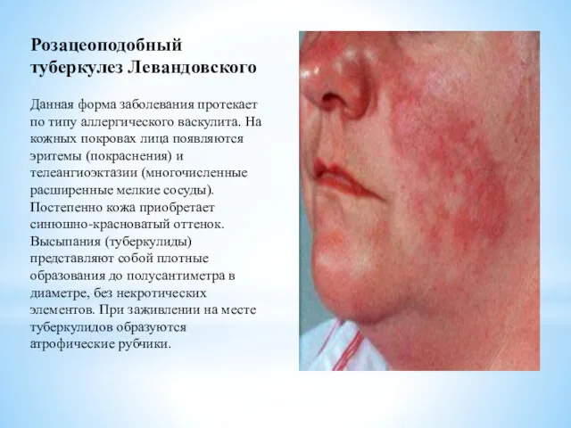Розацеоподобный туберкулез Левандовского Данная форма заболевания протекает по типу аллергического