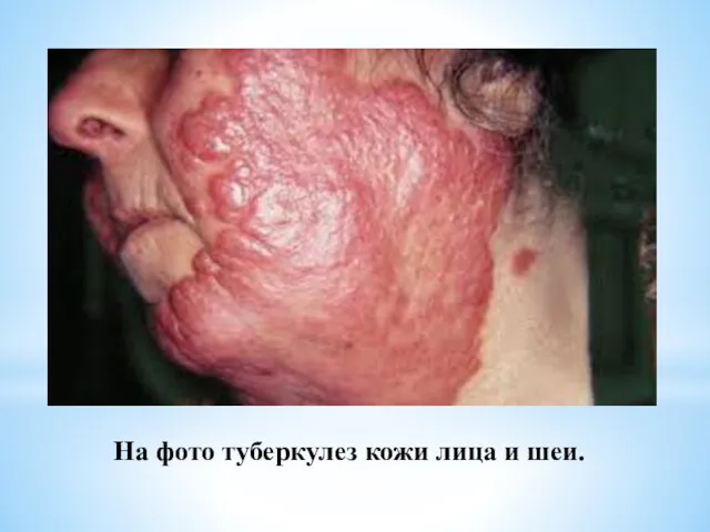 На фото туберкулез кожи лица и шеи.