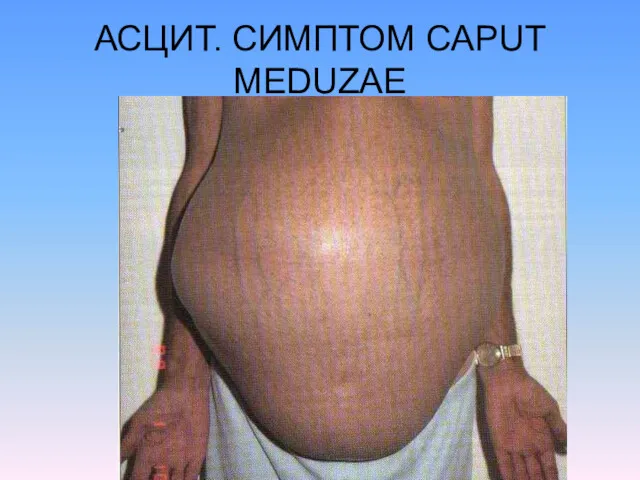 АСЦИТ. СИМПТОМ CAPUT MEDUZAE