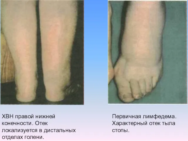 ХВН правой нижней конечности. Отек локализуется в дистальных отделах голени. Первичная лимфедема. Характерный отек тыла стопы.