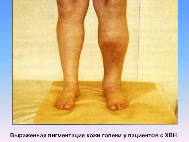 Выраженная пигментация кожи голени у пациентов с ХВН.