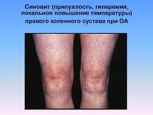 Синовит (припухлость, гиперемия, локальное повышение температуры) правого коленного сустава при ОА