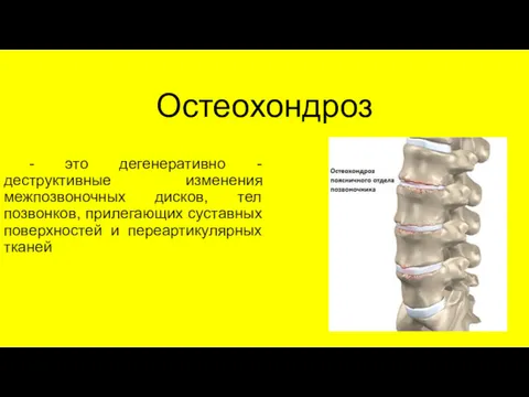 Остеохондроз - это дегенеративно - деструктивные изменения межпозвоночных дисков, тел