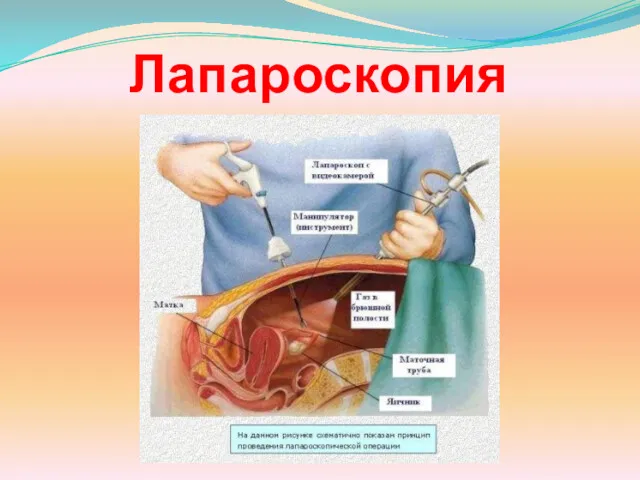 Лапароскопия