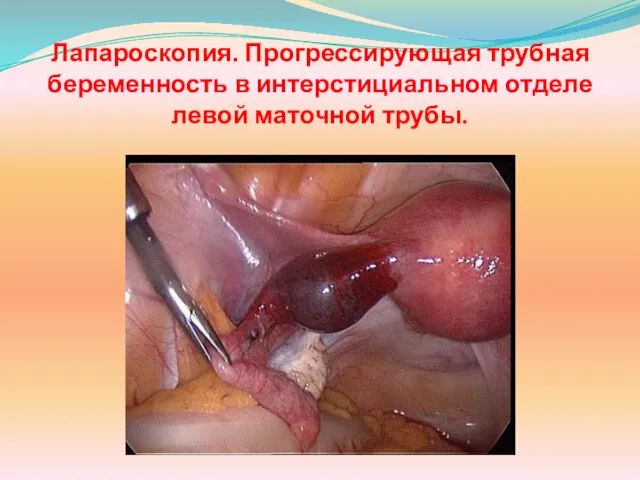 Лапароскопия. Прогрессирующая трубная беременность в интерстициальном отделе левой маточной трубы.
