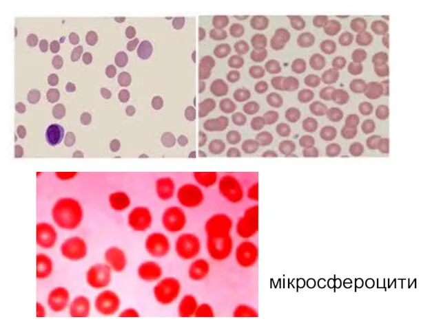 мікросфероцити